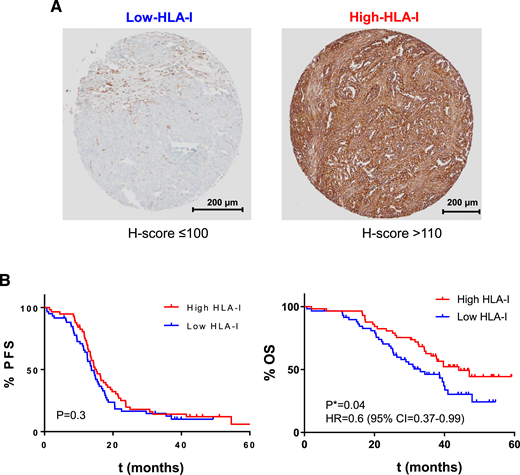 HLA I status in pre-NACT ovarian cancer tumors. A, Representative histology of low- and high-HLA tumors from pre-NACT tumors. Scale bars: 200 μm. B, Kaplan–Meier curves illustrate PFS and OS according to HLA I expression with the median cutoff (H score 110) of the pre-NACT cohort (50% of patients with high–HLA I expression and 50% of patients with low–HLA I expression). A P value of 0.05 was considered significant.