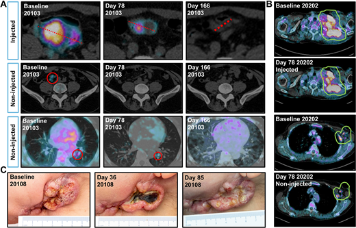 A, Volume and PET signal changes in patient 20103 with metastatic anaplastic thyroid carcinoma, showing disappearance of PET signal for injected abdominal lesion, and disappearance of mesenteric and pulmonal lesions by PET and CT. B, Changes in PET signal in patient 20202 with metastatic NSCLC, showing decrease in PET signal for injected (62% SUVmax decrease) and non-injected lesion (54% SUVmax decrease). C, Visual changes in tumor in patient 20108 with adenocystic adenocarcinoma of the head and neck, showing marked necrosis of the tumor post-treatment.