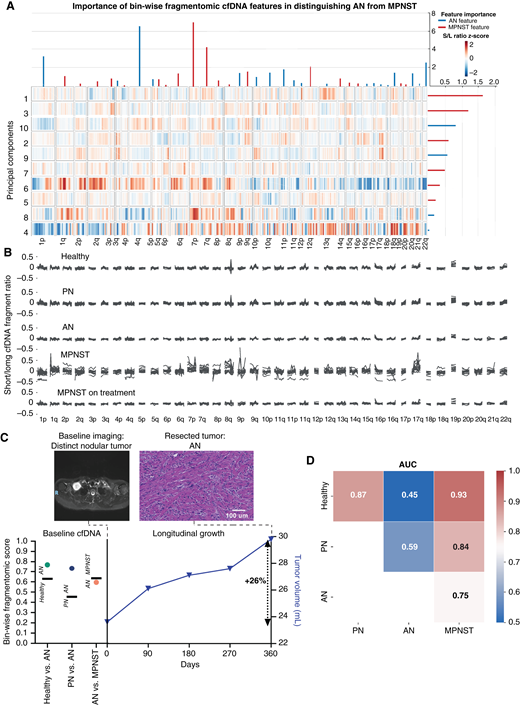 Bin-wise fragmentomic analysis reveals distinct profiles of healthy controls, PN, AN, and MPNST. A, Heatmap of principal component eigenvalues of fragmentation profile features differentiating AN from MPNST. The relative importance of the features is represented at the right (bin-wise short/long ratio changes) and top (chromosomal arm changes) of the heatmap. Red feature importance lines indicate features or principal components associated with MPNST, whereas blue feature importance lines are associated with AN. B, Ratio of short to long fragments in 5-Mb bins across the genome in healthy volunteers and patients with PN, AN, and pretreatment MPNST, and patients receiving treatment for their MPNST. C, Bin-wise fragmentomic scoring and every 3-month surveillance MRI tumor volumes for a patient with AN diagnosed by biopsy, suspicious for malignant transformation given the rate of tumor growth. Fragmentomic scores for healthy vs. AN (green circle), PN vs. AN (purple circle), and AN vs. MPNST (orange circle) along with discrimination thresholds (horizontal black lines) from a paired blood draw are on the left y-axis. Tumor volumes are on the right y-axis, with 26% growth over 1 year indicated. D, OVO ROC AUCs of logistic regression models with 10 repeats of fivefold cross-validation performed over the bin-wise short/long ratio and chromosomal arm z-score data (See “Materials and Methods”). Healthy and disease states included within each comparison are shown along x- and y-axes, with AUC indicated both numerically and by heat level. S/L, short to long.