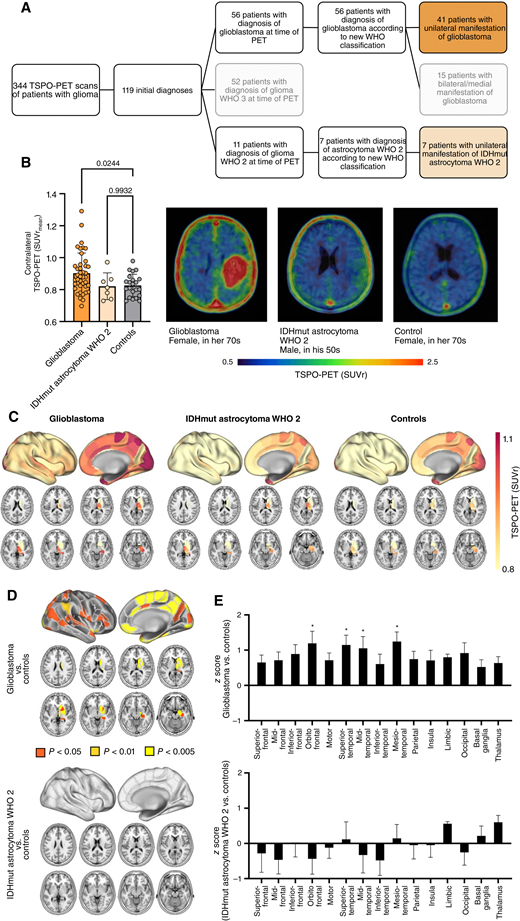 Elevated TSPO-PET signals in the non-lesional hemisphere of patients with glioblastoma. A, Patient selection process. Patients receiving TSPO-PET imaging at initial diagnosis of glioma were allocated. Patients with unilateral manifestation of glioblastoma (WHO IV; n = 41) or isocitrate dehydrogenase mutant astrocytoma WHO grade 2 (IDHmut astrocytoma WHO 2; n = 7) at the time of PET were selected for further analysis. B, Patients with newly diagnosed glioblastoma but not patients with IDHmut astrocytoma WHO 2 indicate higher TSPO-PET signal in the contralateral hemisphere compared to healthy controls. Images represent examples of TSPO-PET images of patients with newly diagnosed glioblastoma (left) and IDHmut astrocytoma WHO 2 (middle) in comparison to a healthy control (right). C, Surface projections and axial slices of the group average contralateral TSPO-PET signal of patients with glioblastoma, IDHmut astrocytoma WHO 2, and healthy controls. The non-lesional hemispheres were parcellated into 123 sub-regions using the Brainnetome Atlas. Axial slices show TSPO-PET signals of basal ganglia regions (masked cortical regions). D, Significant TSPO-PET signal elevation in brain regions of the contralateral hemisphere of patients with glioblastoma but not with IDHmut astrocytoma WHO 2 compared to healthy controls. E, Pronounced contralateral TSPO expression in orbito-frontal, superior-temporal, mid-temporal, and mesio-temporal regions of patients with glioblastoma. *, P < 0.01.