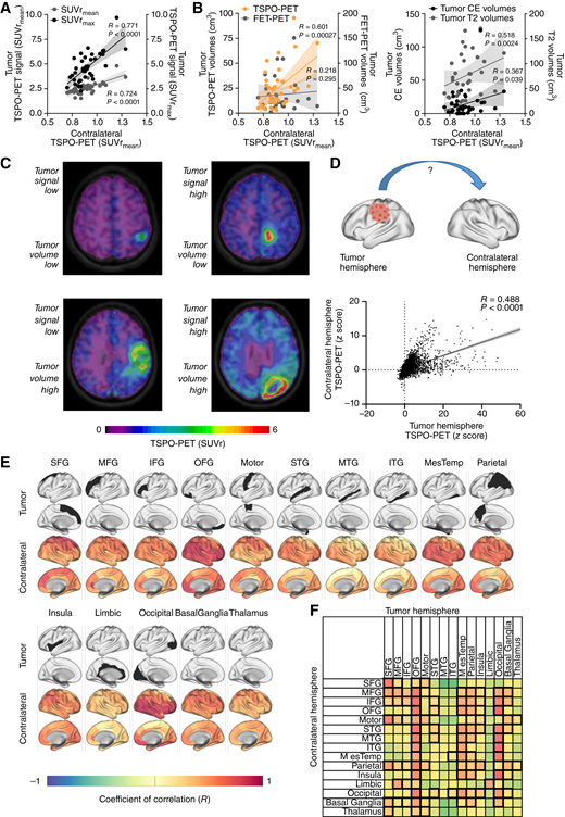 Contralateral TSPO-PET signal elevation is associated with tumor phenotype and localization. A and B, Correlation of contralateral TSPO-PET signals in patients with glioblastoma (n = 38) with the TSPO-PET signal of the tumor (A) and the tumor volume in TSPO-PET, FET-PET (B, left), and MRI (B, right). C, Examples of TSPO-PET images derived from patients with distinct tumor extent and TSPO expression in PET indicate distinct contralateral PET signal elevation. D, Overall correlation between corresponding areas of the tumor and the contralateral hemispheres including all 123 brain sub-regions of each individual patient. E, Correlation of regionally defined tumor seed regions with TSPO-PET signals of the 123 sub-regions in the contralateral hemisphere. Surface projection of tumor seed localization (top rows: seed region, colored in black) and corresponding contralateral coefficients of correlation (bottom rows). IFG, inferior-frontal gyrus; ITG, inferior-temporal gyrus; MesTemp, mesio-temporal; MFG, mid-frontal gyrus; Motor, motor area; MTG, mid-temporal gyrus; OFG, orbitofrontal gyrus; SFG, superior-frontal gyrus; STG, superior-temporal gyrus. F, Correlation of both hemispheres within 15 previously defined anatomically and functionally connected brain regions. Highest coefficients of correlation are colored in red, significant correlations are highlighted by thick boundaries.