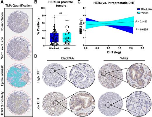 Figure 2. HER3 expression inversely correlates with intraprostatic DHT in AA men. A, A TMA containing prostate tumor specimens from AA and White men was stained for HER3 and analyzed for HER3 positivity. Representative images of the TMA quantification pipeline are shown; normal areas of the cores were excluded from analysis (norm. exclusion) and HER3 was specifically quantified in epithelial cells (epithelial mask). B, HER3 percent positivity was not significantly different between AA and White prostate tumor cores (ns = not significant). C, HER3 expression (log) was negatively correlated with intraprostatic DHT (log) in AA men (P = 0.0255), but not in White men (P = 0.4485). D, Representative images of HER3 staining (brown) in AA and White cores with high versus low intraprostatic DHT. Hematoxylin was used as a nuclear counterstain (blue).