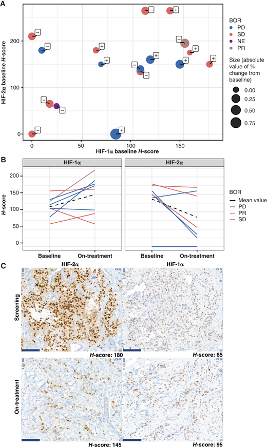 IHC expression analysis of HIF-1α and HIF-2α: (A) HIF-1α versus HIF-2α baseline H-score in patients receiving DFF332, (B) evolution of HIF-1α and HIF-2α with DFF332 therapy, and (C) representative images. In (A), the size of the bubble is proportional to the percentage change in tumor sum of longest diameters; “±” indicates increase/decrease. IHC analysis is reported for patients for whom the full dataset (IHC on the baseline biopsy, baseline and on-treatment staining, or both) is available. In (C), tumor sections were stained using a fully automated system (Ventana Discovery Benchmark, Ventana Medical System) with a rabbit monoclonal anti-HIF-2α, clone D6T8V (Cat. No. 59973; Cell Signaling Technology), or with a rabbit monoclonal anti-HIF-1α, clone EP118 (Cat. No. BSB2520; Bio SB), primary antibody. The percentage of stained tumor cells and tumor positivity was scored using an H-score (0–300) by a certified pathologist. Scale bar, 80 μm. IHC, immunohistochemical; NE, nonevaluable; PD, progressive disease; PR, partial response; SD, stable disease.