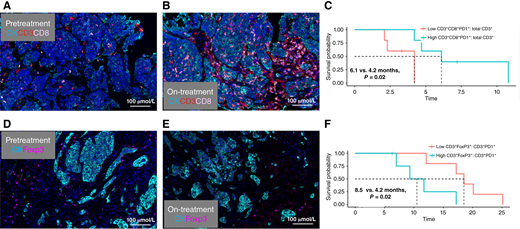 mIF visualization of CD3+CD8+ cells increases from pretreatment (A) to on-treatment (B) biopsies in a tumor responding to treatment, consistent with favorable PFS for tumors with higher CD3+CD8+PD1+ expression (C). Decreases from pretreatment (D) to on-treatment (E) tumor biopsies in a tumor responding to treatment, corresponding to improved PFS for lower expression of CD3+FoxP3+ cells (F).