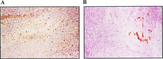 Fig. 4. Immunohistochemical staining of leiomyosarcoma (A) and breast carcinoma (B) with vWf. ×400.
