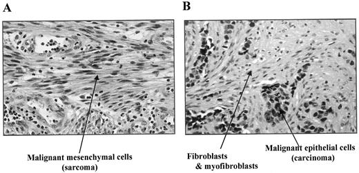 Fig. 5. H&E staining of sarcoma (A) and breast carcinoma (B).