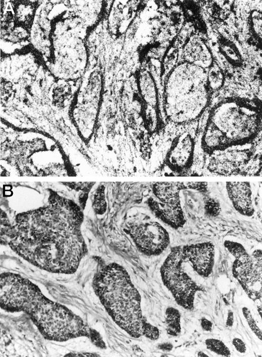 Fig. 7. In situ hybridization of TIMP-1 (A) and H&E staining in breast carcinoma (B). The TIMP-1 signal was observed only within the stromal cells and not the carcinoma cells.