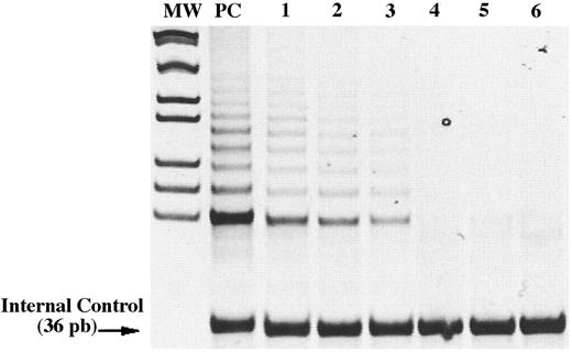 Fig. 1. Detection of telomerase activity in HEC from breast cancer patients. PAGE separation of telomerase ladder obtained from HEC from three different patients (Lanes 1, 2, and 3) and respective heat- inactivated controls (Lanes 4, 5, and 6). Lane PC, positive control; Lane MW, molecular weight marker