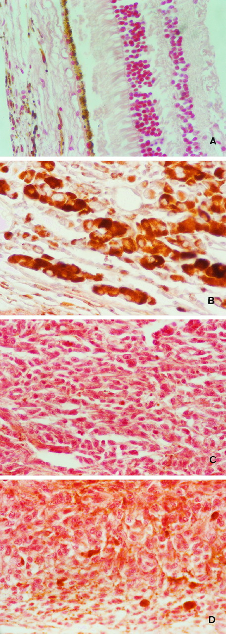 Fig. 1. A, expression pattern of pRb2/p130 in normal retina and choroid. Choroid is on the left of the figure (APAAP, ×500). B, negative expression of pRb/p105 in an epithelioid melanoma (APAAP, ×500). C, high expression level of p107 in a spindle cell melanoma (APAAP, ×500). D, high expression level of pRb2/p130 in a mixed cell melanoma (APAAP, ×500).