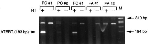 Fig. 4. RT-PCR analysis of hTERT gene expression in thyroid neoplasms. RT, reverse transcriptase; M, molecular size marker is ΦX174-HaeIII digest. RNA (200 ng) from FNA samples and 20 ng RNA from ARO cells were used