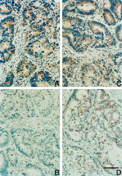 Fig. 1. Immunohistochemical staining of tie-1 and axl/ufo tyrosine kinases in human gastric adenocarcinoma sections. Anti-tie-1 and anti-axl/ufo protein antibodies were used for immunohistochemical staining in human gastric cancer tissues by ABC methods as described in “Materials and Methods.” A, positive tie-1 PTK immunoreactivity existed in the cytoplasm, not in the nucleus of gastric cancer cells. B, absence of tie-1 immunoreactivity was observed in the presence of tie-1-blocking peptide in the staining reaction. C, tie-2-blocking peptides fail to block tie-1 immunoreactivity in the anti-tie-1 antibody stain reaction. D, positive axl/ufo PTK immunoreactivity in the cancer cells (original magnification, ×400). Scale bar, 100 μm.