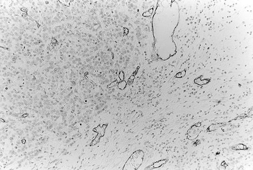 Fig. 2. Detection of microvessels in cancer tissue by immunostaining for CD34. The microvessels were found to be most numerous at the periphery of the tumor (“hot spot”).