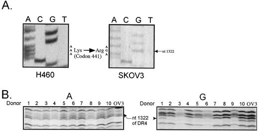 Fig. 5. K441R polymorphism found in the death domain of DR4. A, A-to-G transition at nucleotide 1322 of DR4 in SKOV3 cells. RT-PCR was performed as described in the text. PCR products were cloned into a TA cloning vector (Invitrogen) followed by sequencing using cloned plasmid as a template. Approximately 50% of the clones contained the K441R polymorphism. TRAIL-sensitive DR4-expressing cell lines such as H460 (and HCT116, data not shown)have A at nucleotide 1322, but resistant cell lines such as SKOV3 (and J82, data not shown) have G encoding arginine instead of lysine at codon 441. B, A-to-G transition is found in a normal population. PCR amplification using genomic DNA isolated from whole blood of normal healthy donors as a template was performed and followed by cycle sequencing. Samples from each termination mix were loaded together for easy comparison. Donors 1 and 10 showed A-to-G transition,and also, they were heterozygous. SKOV3 also shows an A-to-G transition and is heterozygous.