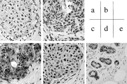 Fig. 1. Immunohistochemical staining of TRX in breast cancer tissues and normal mammary glands (×400). a−d, cancer tissue; e, normal mammary duct. a, negative; b−e, positive. Scores: a, cytoplasm, −; nucleus, −; b, cytoplasm, +; nucleus, +++; c, cytoplasm, +++; nucleus, +; and d, cytoplasm, ++; nucleus, +++; e, cytoplasm, ++; nucleus, +++.