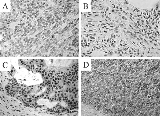 Fig. 3. Correlation between TRX expression and MI in ER/p53 intact group (×200). A and B, case 78. ER+/p53−, MI = 3. A, TRX staining, negative. Score: cytoplasm, +; nucleus, −. B, pS-2 staining, negative. Score: 0. C and D, case 126. ER+/p53−, MI = 1. C, TRX staining, positive. Score: cytoplasm, ++; nucleus, +++. D, pS-2 staining, positive. Score, 3.