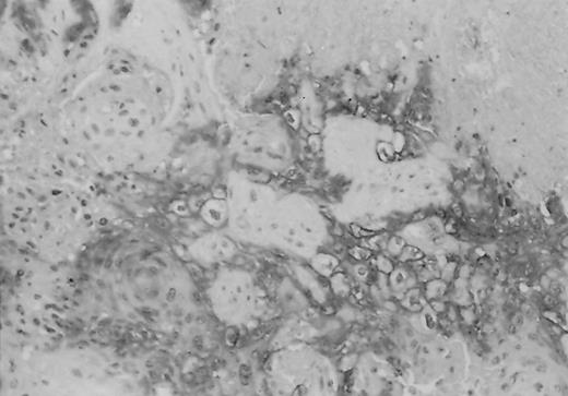 Fig. 1. SSCHNC with strong membrane and cytoplasmic expression of CA9 located around areas of necrosis (×100).