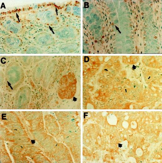 Fig. 2. Immunohistochemical staining for SPN using a monoclonal antibody 3F10, in sections of nonmucinous CRCs. A, in histologically normal colonic epithelium, varying intensity of staining of the SPNNAC with no or faint cytoplasmic staining was observed. Strong nuclear SPN was observed in the superficial epithelial layer. Magnification, ×100. B, moderate to strong nuclear and faint cytoplasmic SPN staining was observed in the upper one-third of the epithelium. Magnification, ×160. C, low to moderate intensity of nuclear and/or cytoplasmic SPN staining was observed in the basal layer (bottom one-third) of the mucosa adjoining adenocarcinomas (long arrow), and strong cytoplasmic SPN localization of was observed in the invasive carcinoma (short arrow). Magnification, ×100. Moderate to strong cytoplasmic (D and E) and faint nuclear (F) staining for SPN in cells of an adenocarcinoma was noted. Magnification, ×160 (D) and ×100 (E and F).