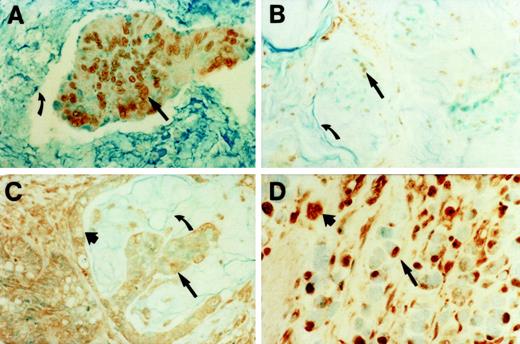 Fig. 3. Immunohistochemical localization of SPN in mucinous CRCs. A, in an island of invasive malignant cells, surrounded by mucin (curved arrow), SPN staining was observed primarily in the nuclei at moderate to strong intensity (straight arrow), and a low intensity of staining for SPN was detected in the cytoplasm. Magnification ×100. B, in some tissue sections of a mucinous adenocarcinoma, a faint to low intensity of staining for nuclear SPN (straight arrow) was observed in malignant cells scattered in the intratumor mucin (curved arrow). Magnification, ×60. C, varying intensities of nuclear and cytoplasmic staining for SPN was noted in some mucinous tumors. Magnification ×100. D, strong localization of nuclear SPN was demonstrated in a mucinous CRC. Magnification, ×160.