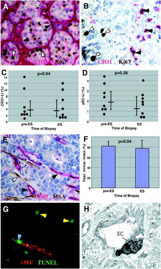 Fig. 2. Characterization of blood vessels in tumor biopsies. Samples of tumor tissue were obtained prior to and 8 weeks after initiation of endostatin treatment. Paraffin sections were analyzed with three dual-labeling reactions (A, B, E, and G) to assess vascular density, endothelial cell proliferation, blood vessel maturity, and endothelial cell death. A, section of a metastatic renal cell carcinoma. Dual labeling is shown for the endothelial marker CD31 (magenta) and proliferation marker Ki67 (brown). Filled arrowheads indicate the dense vascular network lacking proliferating endothelial cells; open arrowheads indicate proliferating tumor cells (magnification, ×400). B, section of a metastatic poorly differentiated squamous cell carcinoma from the head and neck region. Dual labeling for CD31 (magenta) and Ki67 (brown) is shown. Filled arrowheads indicate proliferating endothelial cells; open arrowheads indicate proliferating tumor cells (magnification, ×400). C, computer-assisted quantitative assessment of tumor vascularity: Vascular density is expressed as CD31-LI. •, individual measurements. The horizontal lines indicate the geometric mean; the vertical lines indicate the 95% confidence interval. D, computerassisted quantitative assessment of endothelial cell proliferation (pEC-LI). •, individual measurements; The horizontal lines indicate the geometric mean; the vertical lines indicate the 95% confidence interval. E, section of metastatic colorectal carcinoma. Dual labeling for CD31 (magenta) and MSA as pericyte marker (brown) is shown. Filled arrowheads indicate immature blood vessels lacking pericytes; open arrowhead indicates MSA-positive stromal myofibroblasts (magnification, ×400). F, semiquantitative assessment of blood vessel maturity. Blood vessels sheathed by pericytes and blood vessels lacking pericytes were counted manually with a grid ocular. The results were expressed as VII (Vasc. Immat. Index), defined as the ratio of immature blood vessels lacking pericytes to the total number of blood vessels. The columns indicate means; the bars indicate 95% confidence intervals. G, section of high-grade sarcoma, Endothelial cell apoptosis was detected by dual labeling for endothelial cell marker vWF (red) and apoptosis by the TUNEL assay (green). Blood vessels contain only rare apoptotic cells (yellow arrowhead), whereas numerous tumor cells undergo apoptosis (light blue arrowheads; magnification, ×630). H, section of ovarian carcinoma, as shown by transmission electron microscopy. A capillary is lined by swollen endothelial cells (EC) and surrounded by fibrillar collagen (C). Magnification, ×5200. ES, endostatin.
