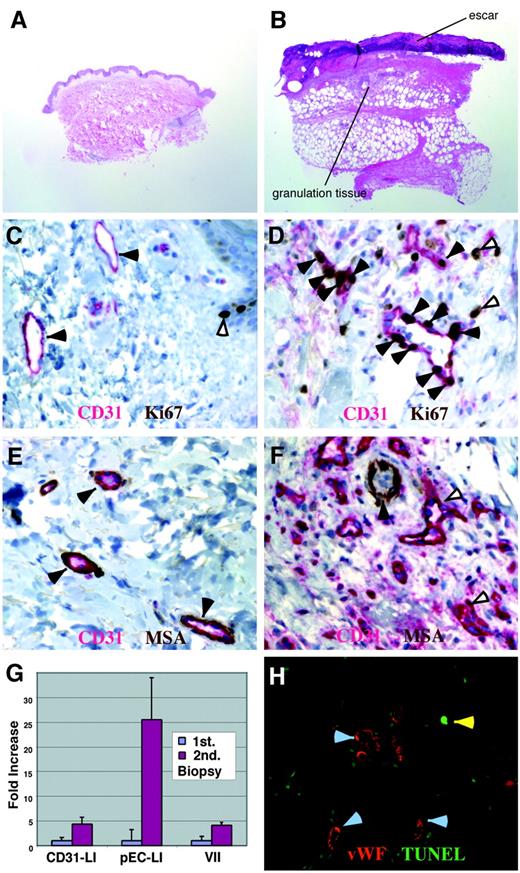 Fig. 3. Skin wounding assay to measure angiogenic activity in vivo. A 4-mm punch biopsy of skin was taken to generate a wound site. Seven days later, the wound site was biopsied. Paraffin sections of the normal skin tissue present in the first biopsy sample and of wound site tissue present in the second biopsy sample were stained with H&E (A and B) and analyzed with three dual-labeling reactions (C–F and H) to assess vascular density, endothelial cell proliferation, blood vessel maturity, and endothelial cell death. A, H&E-stained section of normal skin from first biopsy sample (magnification, ×20). B, H&E-stained section from second biopsy sample. Dermis and subcutis contain a florid granulation tissue, and the skin surface is covered by escar (magnification, ×20). C, section of normal skin, showing dual labeling for the endothelial marker CD31 (magenta) and the proliferation marker Ki67 (brown). Filled arrowheads indicate blood vessels with quiescent endothelial cells; open arrowhead indicates proliferating basal keratinocyte (magnification, ×400). D, section of wound site showing dual labeling for CD31 (magenta) and Ki67 (brown). Filled arrowheads indicate proliferating endothelial cells; open arrowheads indicate proliferating cells other than endothelial cells (magnification, ×400). E, section of normal skin showing dual labeling for CD31 (magenta) and MSA as pericyte marker (brown). Filled arrowheads indicate mature blood vessels sheathed by pericytes (magnification, ×400). F, section of wound site showing dual labeling for CD31 (magenta) and MSA (brown). Open arrowheads indicate immature blood vessels lacking pericyte sheathing; filled arrowhead indicates a sweat duct as an internal positive control (magnification, ×400). G, quantitative assessment of vascular density (CD31-LI), endothelial cell proliferation (pEC-LI), and blood vessel maturity (VII) in three pairs of first and second biopsies. Results are expressed as Fold stimulation relative to results of first biopsy; bars, 95% confidence intervals. Wounding induces active angiogenesis with an increase of all three parameters. H, section of wound site showing detection of endothelial cell apoptosis by dual labeling for endothelial cell marker vWF (red) and apoptosis by TUNEL assay (green). Blood vessels (light blue arrowheads) contain only very sparse apoptotic cells (not seen in this section), whereas occasional extravascular stromal cells (yellow arrowhead) and keratinocytes (not seen in this section) undergo apoptosis (magnification, ×200).