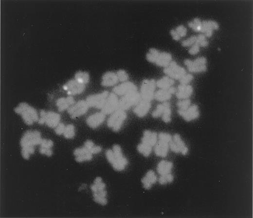 Fig. 1. FISH analysis with chromosome 6 α-satellite and YAC clone 4HE8 as probes on TBM case 8 metaphase. The loss of YAC clone 4HE8 region in the interval defined by markers D6S193 and D6S149 was observed on one chromosome 6 homologue.