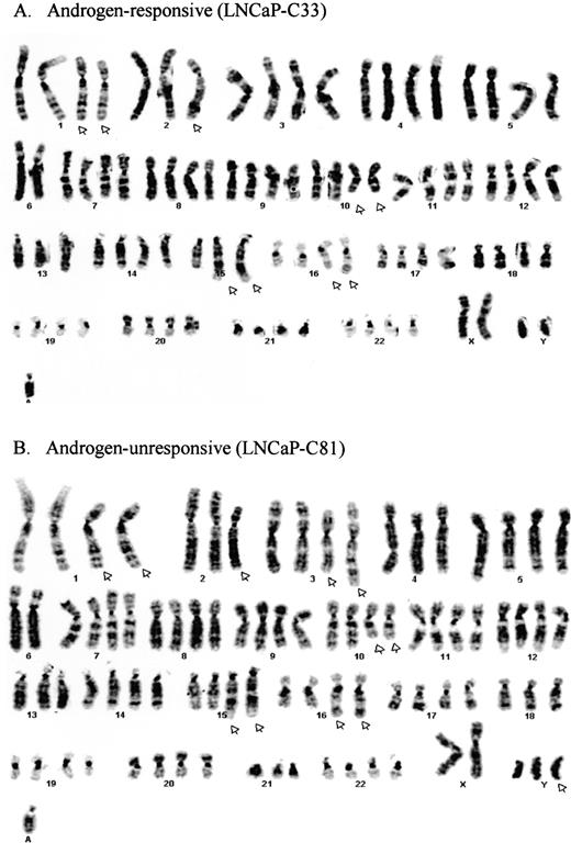 Fig. 2. A, representative karyotypes of LNCaP-C33 cells characterized by structural and numerical abnormalities. B, an identical chromosomal pattern observed in LNCaP-C81 cells with the additional structural rearrangement in chromosome 3 and the gain of one copy of a Y chromosome. The structural and numerical abnormalities are indicated by arrows in both cases.
