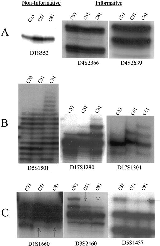 Fig. 4. Representative examples of microsatellite DNA markers amplified by PCR and analyzed on a denatured 6% polyacrylamide gel in C33 (early), C51 (mid), and C81 (late) stages of the LNCaP cell model. A, a noninformative case and informative cases without allelic imbalances; B, MSI; C, AL (indicated by arrow) in mid (C51) and late (C81) stage cells. Early-stage C33 LNCaP cells served as the control.