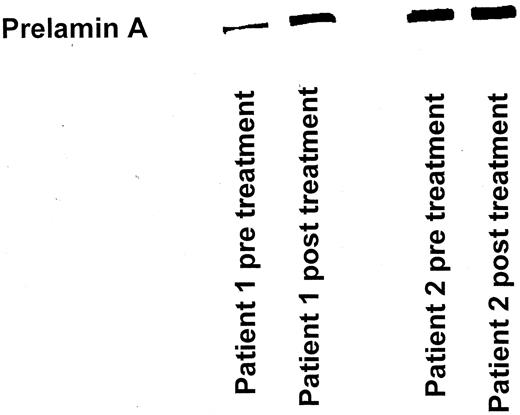 Fig. 5. Increases in prelamin A in patient PBL samples before and after treatment with R115777 (samples collected after patients had received 300 mg twice daily every day for 4 weeks) in Patient 1 (who exhibited a partial response) and Patient 2 (who did not respond). In two patients (nonresponders), there was no detectable prelamin A in either sample.