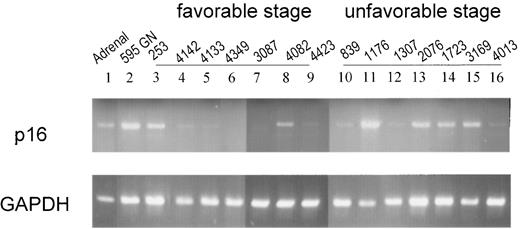 Fig. 1. Expression of p16 mRNA in primary neuroblastoma. The mRNA expression of p16 in neuroblastoma was determined by using RT-PCR. All of the levels of gene expression are in comparison with that of GAPDH. Lane 1, normal adrenal gland (Adrenal); Lane 2, GN; Lanes 3–16, neuroblastoma tumors obtained at different stages. The p16 mRNA levels were determined as a ratio to GAPDH mRNA.