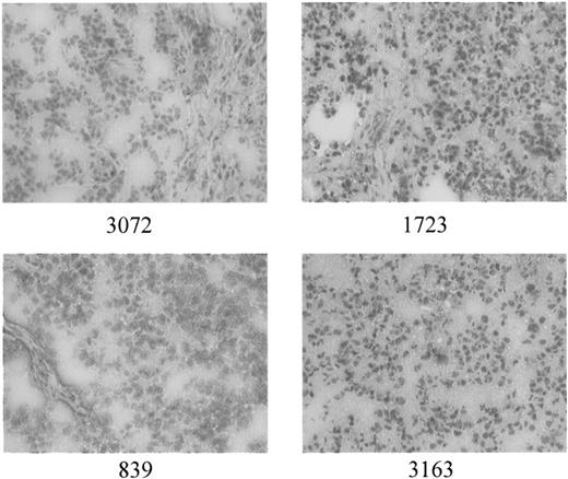 Fig. 3. Immunohistochemical analysis of p16 in primary neuroblastoma. Samples 1723 and 3163 showed strong staining in the majority of tumor nuclei. p16 protein was also detected in these samples by Western blot. Samples 3072 and 839 showed predominantly negative staining. p16 protein was not detected in either of these samples by Western blot.
