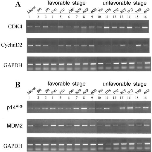 Fig. 5. Expression of CDK4 and cyclin D2 (A) and p14ARF and MDM2 (B) in primary neuroblastoma. mRNA expression of these genes in neuroblastoma was analyzed by using RT-PCR. GAPDH is shown as a control. Lane 1, normal adrenal gland; Lane 2, GN; and Lanes 3–16, neuroblastoma samples obtained at different stages.