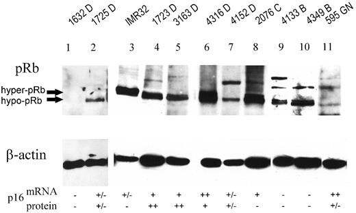 Fig. 6. Expression of pRb protein in primary neuroblastoma. Protein expression of p16 in neuroblastoma was determined by using Western blot analysis. All of the levels of protein expression are in comparison with that of β-actin. Lanes 1, 2, and 4–10, neuroblastoma samples obtained at different stages; Lane 3, IMR32 (neuroblastoma cell line) showed predominantly hyperphosphorylated pRb (33); and Lane 11, GN.