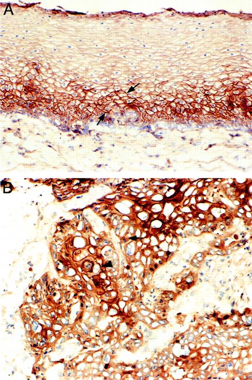 Fig. 3. Photomicrographs of MET expression by IHC staining in morphologically normal esophageal epithelium and ESCC. A, MET IHC in morphologically normal esophageal epithelium showing MET expression was restricted to the parabasal cell layer (arrow), 3,3′-diaminobenzidine; ×400. B, MET IHC in ESCC showing the cytoplasm (arrow) and cell membrane (arrowhead) of most tumor cells are strongly positive for MET, 3,3′-diaminobenzidine; ×500.