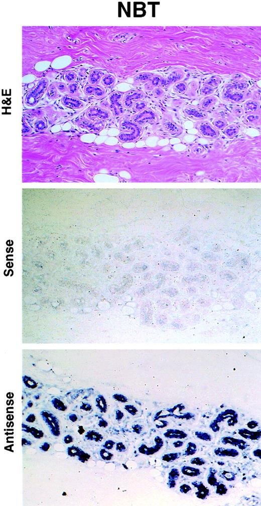 Fig. 1. Normal breast lobule expressing a high level of NES1 mRNA. Top panel, H&E-stained tissue section; middle panel, absence of staining with NES1 mRNA sense probe; bottom panel, intense staining with NES1 mRNA antisense probe. NBT, normal breast tissue. ×100.