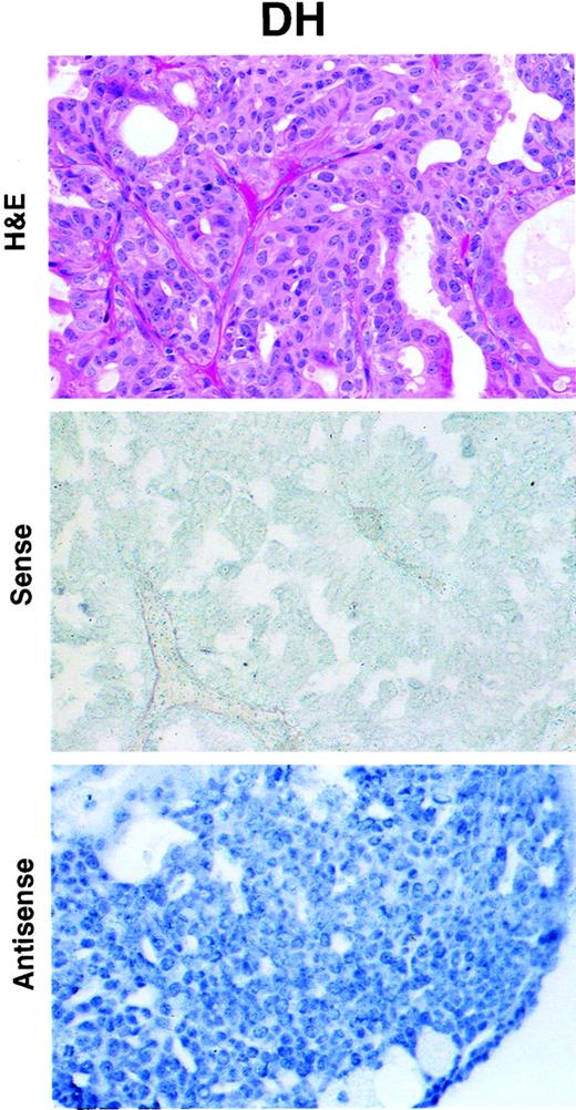 Fig. 2. DH expressing a high level of NES1 mRNA. Top panel, H&E- stained tissue section; middle panel, absence of staining with NES1 mRNA sense probe; bottom panel, intense staining with NES1 mRNA antisense probe. ×200.