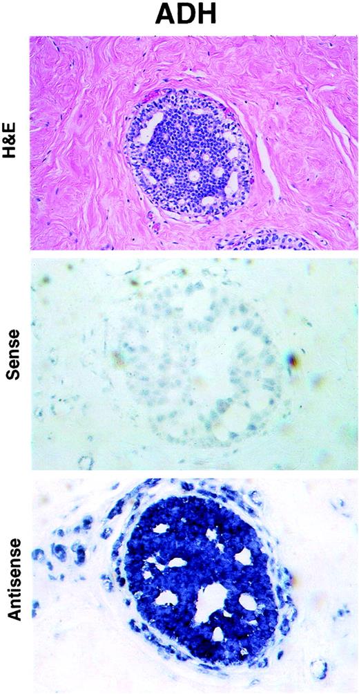 Fig. 3. ADH expressing a high level of NES1 mRNA. Top panel, H&E-stained tissue section; middle panel, absence of staining with NES1 mRNA sense probe; bottom panel, intense staining with NES1 mRNA antisense probe. ×100.