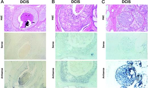 Fig. 4. A, duct containing high-grade DCIS with comedo necrosis and calcification lacking NES1 mRNA expression. Top panel, H&E- stained tissue section; middle panel, absence of staining with NES1 mRNA sense probe; bottom panel, absence of staining with NES1 mRNA antisense probe. ×200. B, duct containing high-grade DCIS with comedo necrosis expressing a low level of NES1 mRNA. Top panel, H&E- stained tissue section; middle panel, absence of staining with NES1 mRNA sense probe; bottom panel, weak staining with NES1 mRNA antisense probe. ×200. C, duct containing an intermediate-grade DCIS expressing a moderate level of NES1 mRNA. Top panel, H&E- stained tissue section; middle panel, absence of staining with NES1 mRNA sense probe; bottom panel, moderate staining with NES1 mRNA antisense probe. ×200.