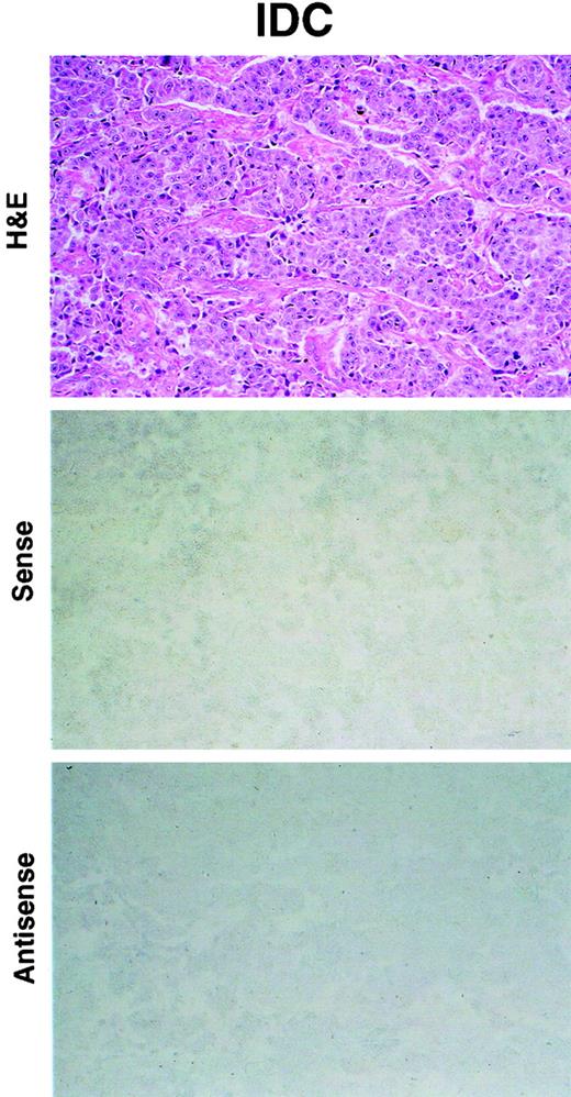 Fig. 5. Grade 2 IDC with lack of NES1 mRNA expression. Top panel, H&E-stained tissue section; middle panel, absence of staining with NES1 mRNA sense probe; bottom panel, absence of staining with NES1 mRNA antisense probe. ×200.