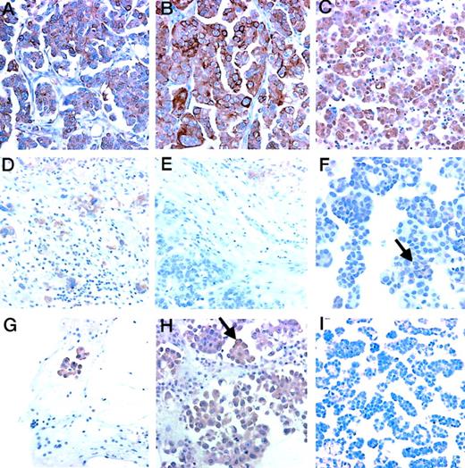 Fig. 1. TrkA and p75 protein expression in effusions, primary carcinomas, and metastases. A, TrkA staining in a primary serous ovarian carcinoma. All carcinoma cells show cytoplasmic immunoreactivity, and some cells show additional localization to the cell membrane. B, TrkA immunoreactivity in a colon metastasis that originated from the primary tumor in A. All cells show similar cytoplasmic immunoreactivity, but the number of membrane-positive cells is higher than in the primary tumor. C, TrkA immunoreactivity in a peritoneal effusion obtained from the same patient. Staining pattern resembles that of tumor cells in the solid lesions. D, p75-positive colon metastasis of a primary serous ovarian. Tumor cells show membrane and cytoplasmic immunoreactivity. E, a p75-negative colon metastasis. Ganglion cells (upper right corner) are stained, providing an internal control in this case. F, p75-positive tumor cells in a peritoneal effusion. Tumor cells show weak cytoplasmic and focal (arrow) membrane immunoreactivity. G, p-TrkA staining in a peritoneal effusion. A group of carcinoma cells show clear membrane immunoreactivity. H, p-TrkA staining in another peritoneal effusion. The majority of carcinoma cells show only cytoplasmic immunoreactivity (not scored as positive), whereas only a few cells show additional localization to the cell membrane (arrow). I, a third peritoneal effusion showing absence of any cells immunoreactive for p-TrkA. This was by far the most common pattern observed using this antibody. The specimens shown in D–F were obtained from three different patients, none of which is the patient whose tumor is shown in A–C. The same is true regarding G–I.