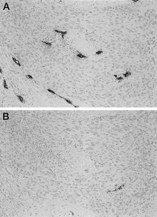Fig. 1. Intratumoral microvessels highlighted with an anti-CD34 mAb (A) and with an anti-CD105 mAb (B). More vessels were recognized with the anti-CD34 mAb than with the anti-CD105 mAb.