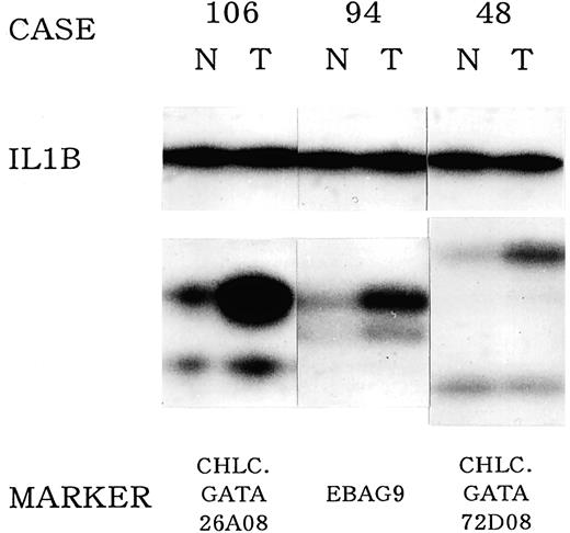 Fig. 5. Representative autoradiographs revealing allelic gain on chromosome 8q23 in primary breast, carcinomas. N and T, DNA samples isolated from normal and tumor tissues respectively. On top of the panel, case number. On the bottom of each autoradiogram, polymorphic markers. IL-1β (IL1B) is control marker.