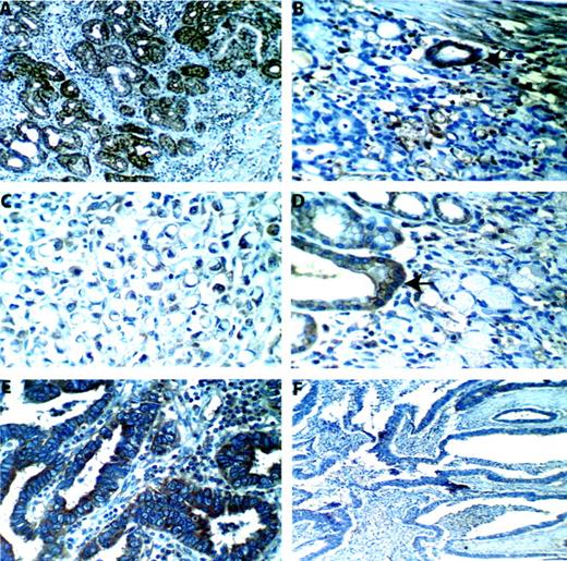 Fig. 2. Fez1 immunostaining in gastric carcinoma. A, uniform strong Fez1 staining in normal gastric glands (×250). B, early gastric cancer showing loss of Fez1 protein expression (case 101; ×250). Fez1 is detected in a normal gland (arrow). C, diffuse carcinoma (signet-ring) showing Fez1 protein expression (case 49; ×400). D, signet-ring cells showing complete absence of Fez1 protein (case 19; ×400). Arrow, normal glands positive for Fez1. E, intestinal gastric cancer showing uniform positive staining for Fez1 protein (case 9; × 400). F, intestinal carcinoma showing complete absence of Fez1 protein (case 6; × 250).