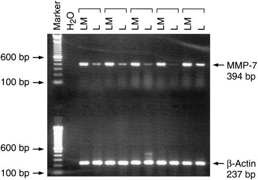 Fig. 1. Representative RT-PCR analysis from 5 CRC liver metastases patients. The total RNA isolated from each tissue was reverse transcribed and PCR-amplified using a specific primer described in “Materials and Methods.” Arrows indicate the MMP-7 (top) or β-actin (loading control; bottom). Lane 1, 100-bp ladder as the size marker; Lane 2, water control; LM, liver metastases; L, corresponding normal liver tissue.