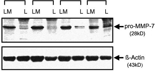 Fig. 2. Western blot analysis for determining the specificity of antibody to MMP-7 under nonreducing conditions. LM, CRC liver metastases; L, normal liver tissue. Top panel, Western blot analysis of MMP-7 under nonreducing conditions. The antibody reacts with protein band corresponding to the molecular weight of pro-MMP-7 (Mr 28,000). Bottom panel, Western blot analysis of β-actin.