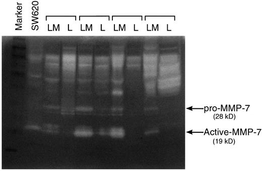 Fig. 3. Casine substrate gel electrophoresis for determining the caseinolytic activities of pro- and activated forms of MMP-7. The casine zymography shows two bands with the approximate sizes of Mr 28,000 and Mr 19,000 (noted by arrows), which correspond to pro- and activated form of MMP-7, respectively. Constitutive secretion of the latent and activated forms of MMP-7 appeared in every liver metastases (LM). In contrast, normal liver tissue (L) exhibited only trace or nondetectable amounts. Lane 1, protein molecular weight standard; Lane 2, colon cancer cell line SW620 as a positive control for MMP-7.