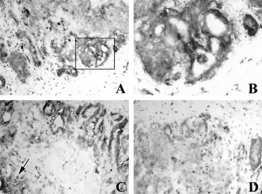 Fig. 4. Immunocytochemical staining for MMP-7 in human CRC liver metastases. In A, there is a different intensity of MMP-7 staining among the different areas of CRC liver metastases, strong immunoreactivity was concentrated in the invasive edge of tumor cells; ×100. B, higher magnification of area bordered in Fig. A. The staining pattern of MMP-7 was predominantly intracytoplasmic; ×400. C, strong immunoreactivity for MMP-7 can be seen in cancer cells, some residual normal liver cells were stained less intensely (noted by arrow) or were negative; ×100. D, negative control with 1% BSA-PBS instead of primary antibody; ×100.