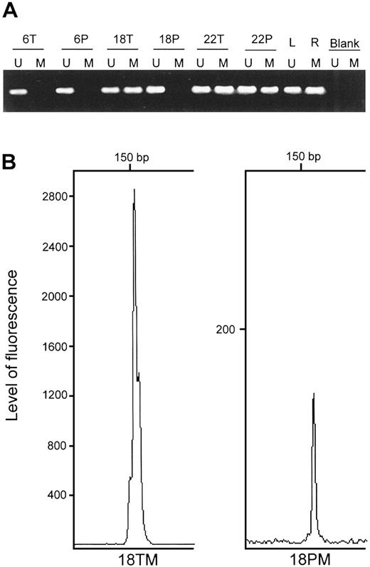 Fig. 1. Analysis of aberrant methylation of p16INK4A gene in tumor (T) and plasma (P) of NSCLC patients. A, STD-MSP of tumor and plasma DNA of patients 6, 18, and 22. Products in Lanes U were obtained with primers for the unmethylated sequence (151 bp), whereas products in Lanes M were obtained with primers for the methylated sequence (150 bp). DNA from normal lymphocytes (L) and Raji lymphoma cells (R) was used as control for the unmethylated and methylated reactions, respectively. Water blanks are included. B, F-MSP of patient 18 tumor and plasma DNA amplified with 6-FAM-labeled primers for the methylated sequence.