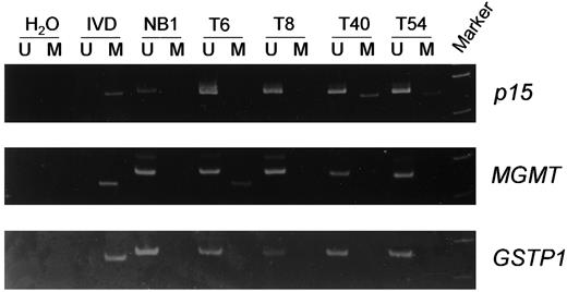 Fig. 2. Methylation analysis of p15, MGMT, and GSTP1 in tumor tissues of bladder cancer patients by MSP. U indicates the presence of unmethylated genes; M indicates the presence of methylated genes. Results for normal bladder urothelium (NB) and carcinoma in situ (CIS) were also included. IVD was used as a positive control for methylation, and water (H2O) was used as a negative control for PCR.