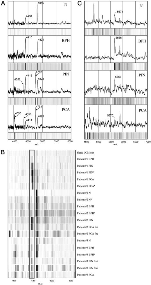 Fig. 2. A, representative spectra and gel-view∗ of matched prostate epithelial cell lysates (normal BPH, PIN, and PCA) showing protein alterations in the range of 4000–5000 Da (m/z). (Arrows indicate overexpressed peaks in PIN and PCA). ∗Gray scale display of the raw spectra called gel-view because it looks like a stained one-dimensional electrophoresis gel. B, SELDI gel-view protein profiles of lysates prepared from cells procured from different prostatectomy specimens. The box identifies a peak with an average mass of 4749 Da that appears to be overexpressed in PIN and PCA epithelial cells. Replicate samples(∗) show good reproducibility of the protein patterns. The different protein patterns observed for two different PCA foci in patient 2 and the two PIN foci in patient 3 may be the result of genetic heterogeneity. C, representative spectra and gel-views of matched prostate epithelial cell lysates showing increased expression of a peak at m/z of 5666 in the BPH sample. N, normal.