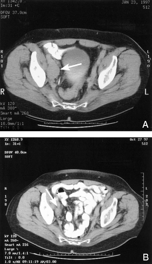Fig. 2. A, pretreatment CT scan of pelvic lymphadenopathy (identified by white arrow) in 1 patient with documented response to 1α-OH-D2. B, week 36 CT scan of the same patient showing regression of pelvic lymphadenopathy (identified by white arrow) meeting definition for a partial response.